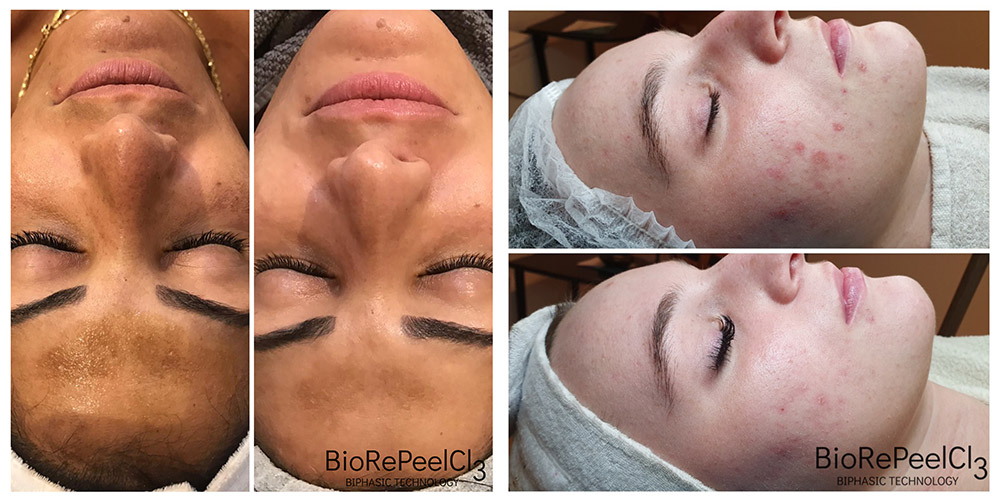 beautylounge-biorepeel-bild1