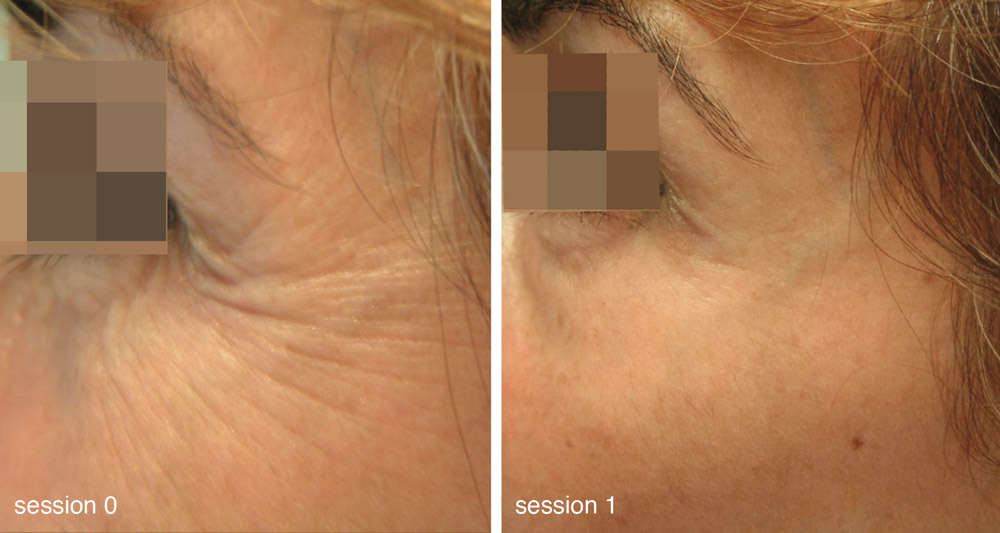 beautylounge-mesoeclat-bild1
