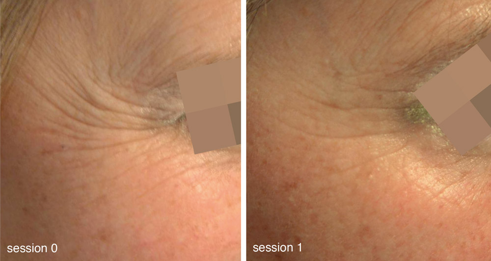 beautylounge-mesoeclat-bild2